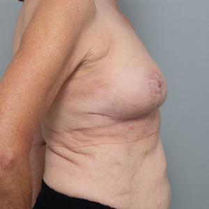 Bilateral breast reduction — 6 weeks postoperative, lateral view