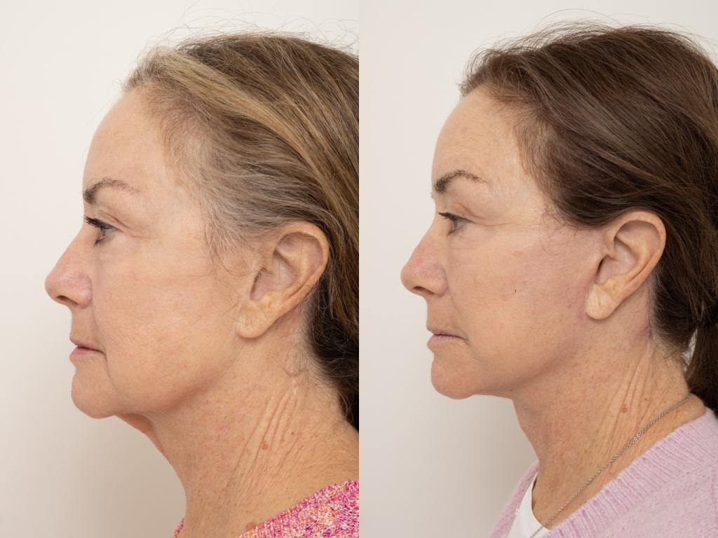 Revision deep plane face and neck lift with fat grafting — preoperative and 6 weeks postoperative, lateral view