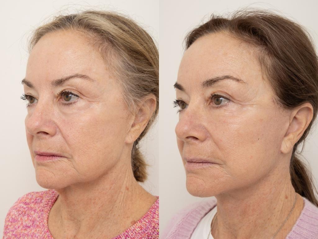 Revision deep plane face and neck lift with fat grafting — preoperative and 6 weeks postoperative, oblique view