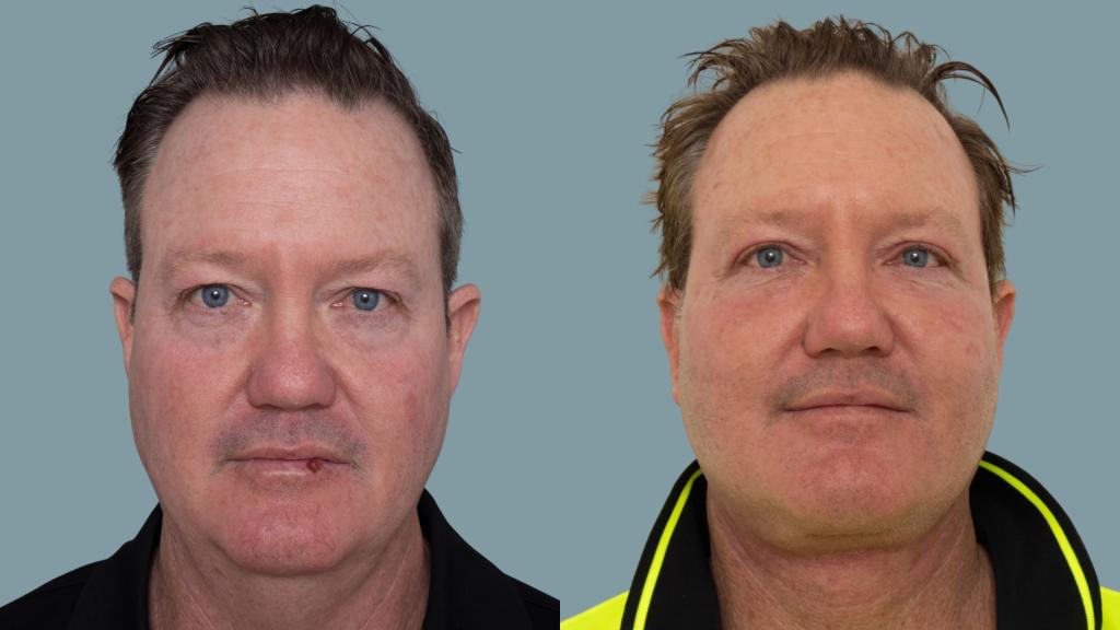 Deep plane face and neck lift with deep neck reduction — preoperative and 6 weeks postoperative, frontal view