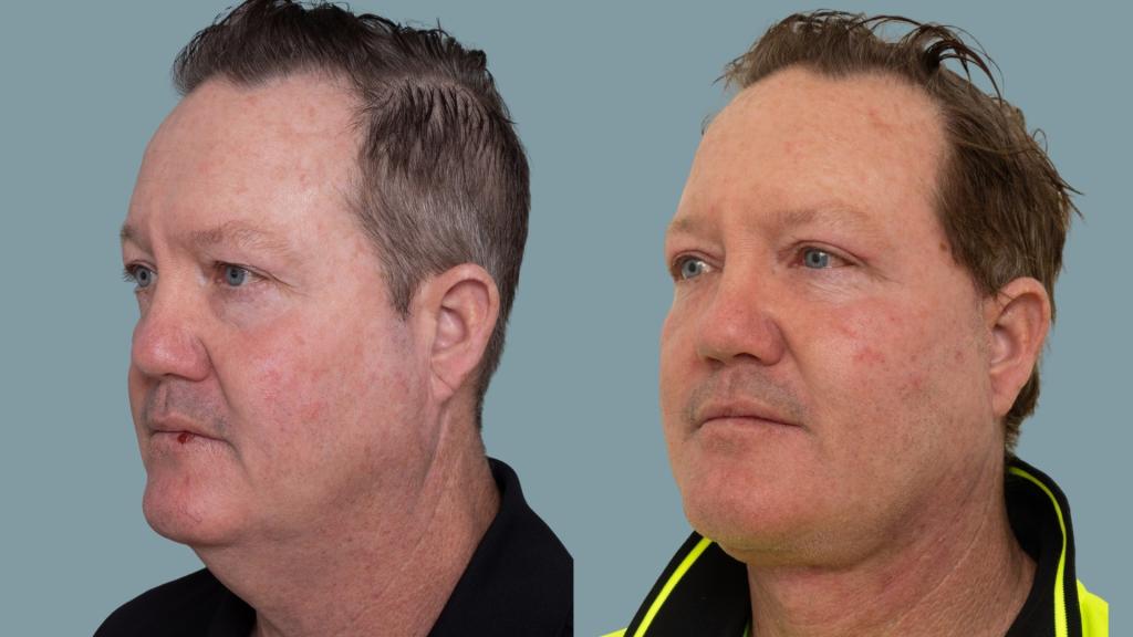 Deep plane face and neck lift with deep neck reduction — preoperative and 6 weeks postoperative, oblique view