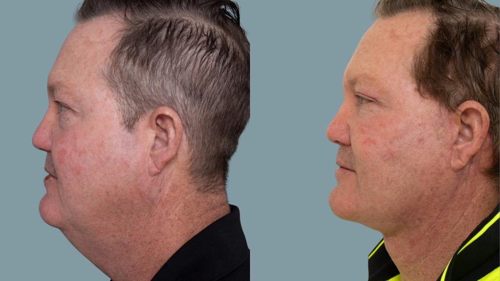 Deep plane face and neck lift with deep neck reduction — preoperative and 6 weeks postoperative, lateral view